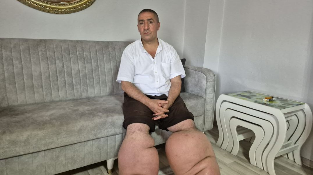 Sultangazi’de fil hastalığıyla 15 yıllık mücadele: "Eşimle dışarı çıkmak istiyorum"